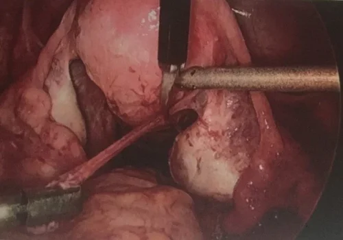 Division of adhesions..