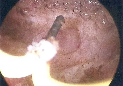Division of the Septum using needle point diathermy