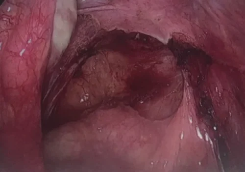 Endometriosis in the Pouch of Douglas is excised.
