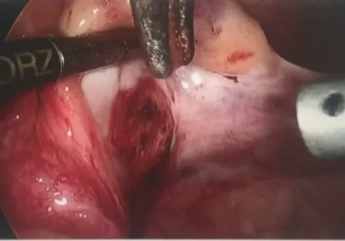 Endometriosis on left side wall is excised.