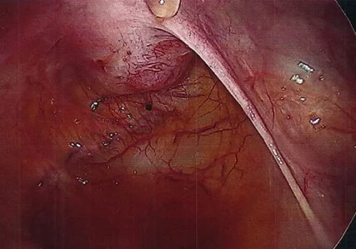 Endometriosis over posterior cervix