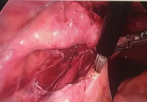 Endometriosis over the left side wall is excised. The left ureter has been dissected out.