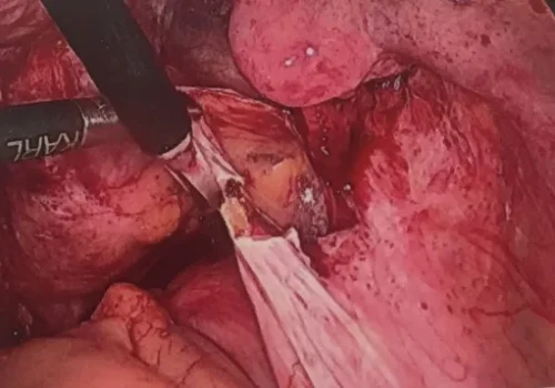 Endometriosis over the right side wall and right utero-sacral ligament is excised.
