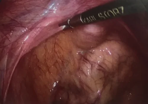 Endosalpingiosis of the left para-rectal area - seen as clear cystic lesions.