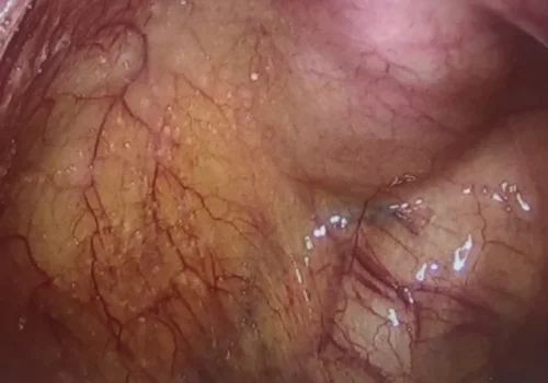 Endosalpingiosis