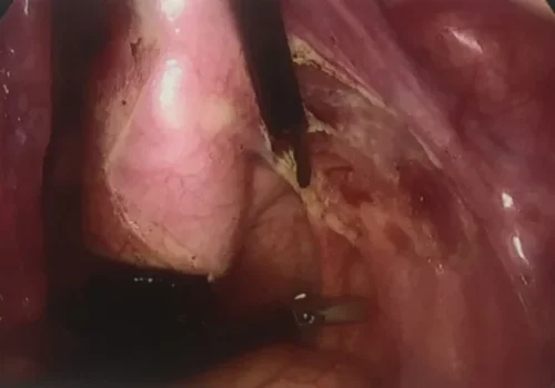 Excision of endosalpingiosis of the right side wall and right utero-sacral ligament.