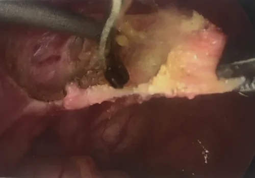 Excision of the endosalpingiosis involving left para-rectal area and left utero-sacral ligament.