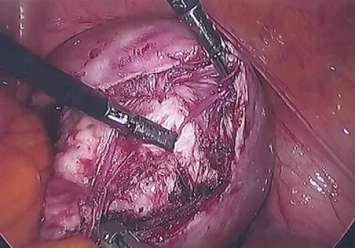 Fibroid being removed