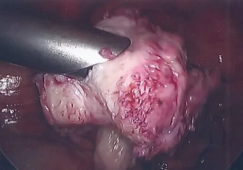 Fibroid is morcellated