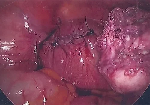 Fibroid next to uterus (left)