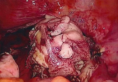 Fibroid uterus is morcellated and removed