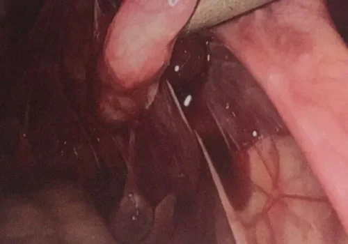 Filmy adhesions involving the right Fallopian Tube.