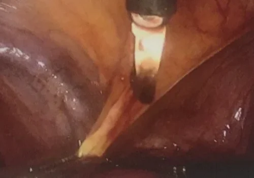 Further excision of endometriosis.