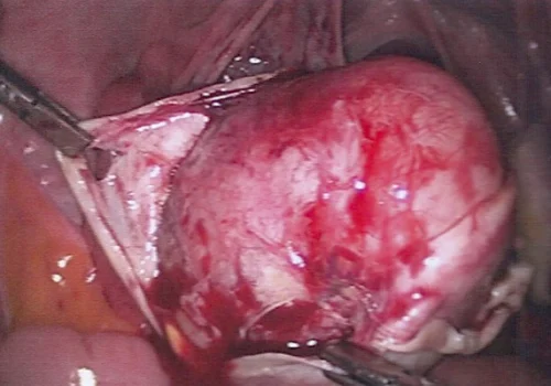 Further exposure of the dermoid cyst