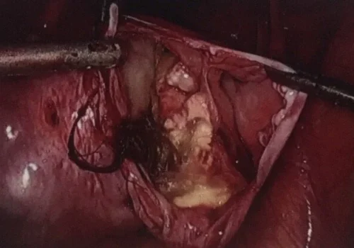 Hair is seen in a dermid cyst.