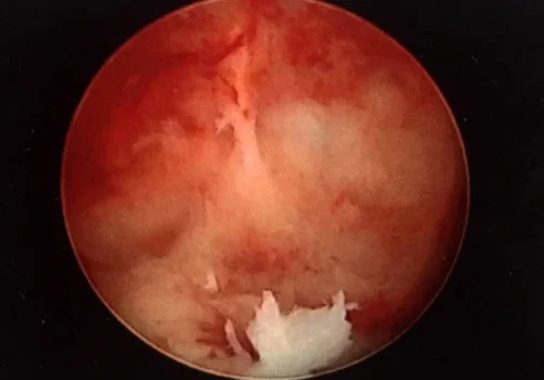 Hysteroscopic view of the cavity of the uterus showing the band at the top