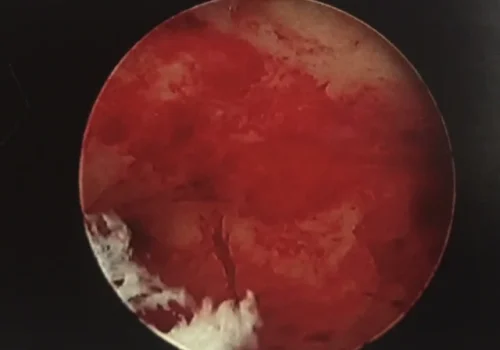 Hysteroscopic view of the normal uterine cavity at the end of the operation. The fibroid has been resected and the band has been divided
