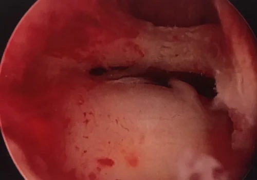 Hysteroscopic view of the uterine cavity showing submucosal fibroid (on the floor) and thick band (above this)