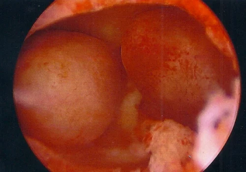 Hysteroscopic view of uterus showing two endometrial polyps