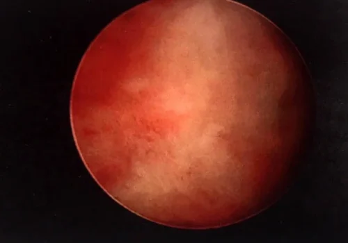 Hysteroscopic view showing normal cavity at the end of the operation
