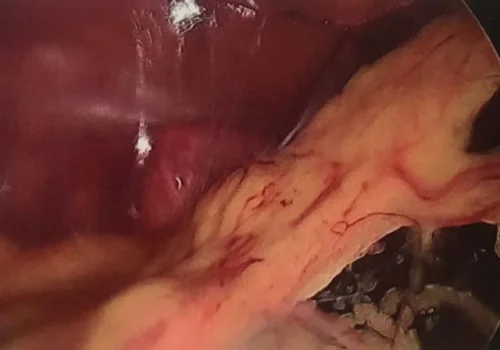 Pelvic adhesions - involving bowel and pelvic organs.
