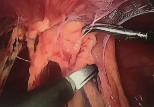 Pelvic adhesions - involving bowel and pelvic organs.