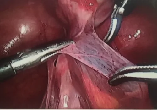Meticulous division of extensive pelvic adhesions.