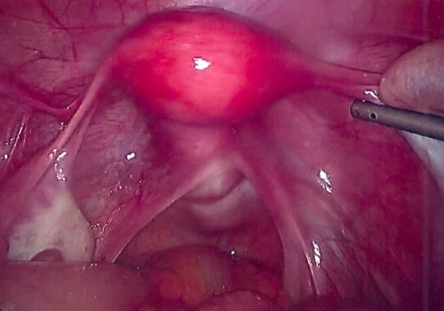 Laparoscopic picture showing normal uterus, left ovarian dermoid and normal right ovary