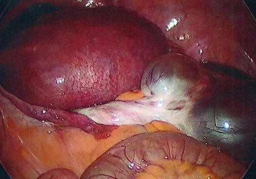 Laparoscopic picture showing pregnant uterus and right ovarian cyst next to this