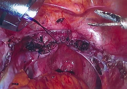 Laparoscopic suturing of vaginal vault – showing a port through which instruments are inserted