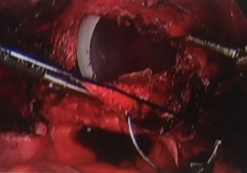 Laparoscopic suturing - to close the vaginal vault.