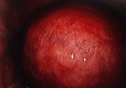 Laparoscopic view of a large fibroid uterus. There was limited access to the pelvic side walls and posterior uterus. The procedure was thus converted to open
