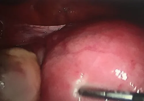 Laparoscopic view of large fibroid uterus and normal left ovary.