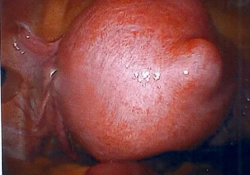 Laparoscopic view of large fibroid uterus