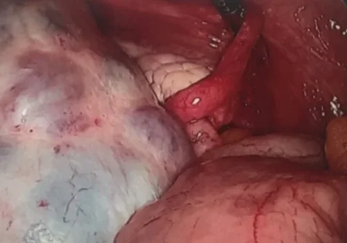 Laparoscopic view of large left ovarian cyst. Adjacent to this is a normal right ovary and appendix.