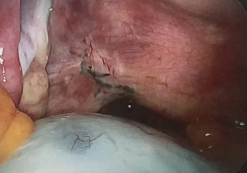 Laparoscopic view of large right ovarian cyst. The endometriosis is seen as a black pigmented area.