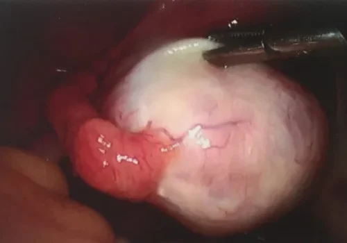 Laparoscopic view of left dermoid cyst.