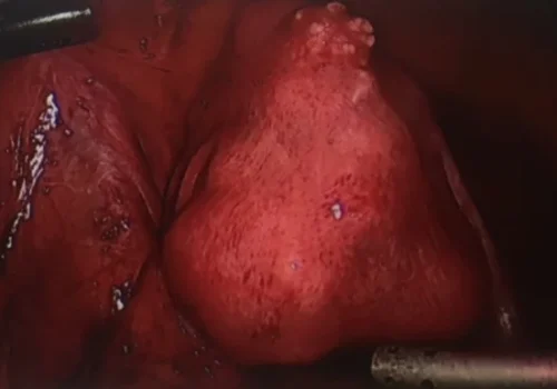Laparoscopic view of multi-fibroid uterus.