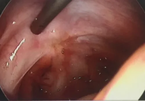 Laparoscopic view of the Pouch of Douglas (behind the cervix). The endometriosis is seen as a pigmented area.