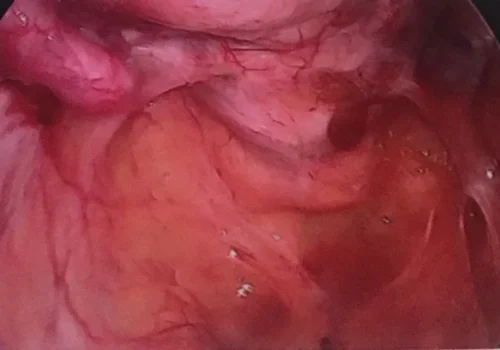 Laparoscopic view of the Pouch of Douglas (the area behind the uterus). There is evidence of recurrent endometriosis.
