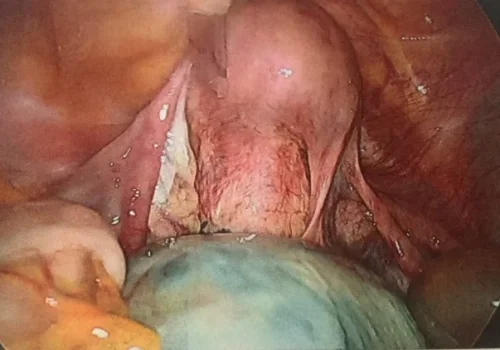 Laparoscopic view of the large right ovarian cyst.