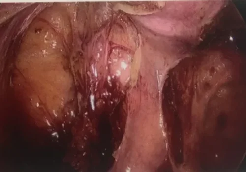 Laparoscopic view of the pelvic demonstrating a large dissection near the rectum to remove all the disease.