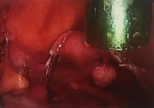 Laparoscopic view of the pelvis at the end of the procedure. There is an incidental finding of a small pedunculated fibroid.
