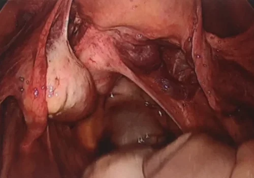 Laparoscopic view of the pelvis. Prominent blood vessels are seen.