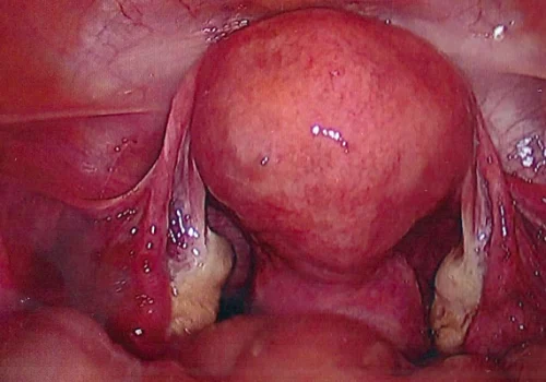 Laparoscopic view of uterus and both ovaries
