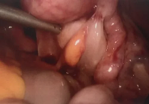 Laparoscopic view showing significant bowel adhesions.