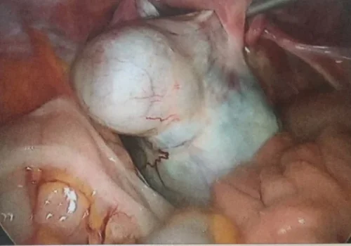 Large bilobed right ovarian cyst.