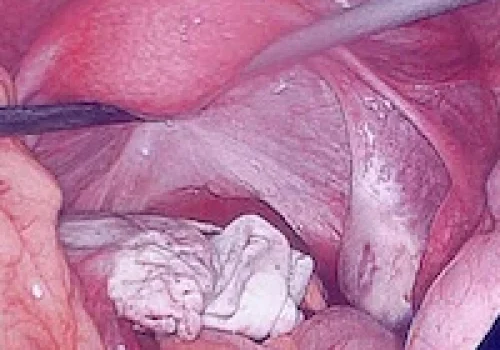 Large cyst of the left ovary. The uterus is seen above