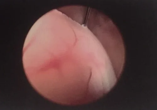 Large fibroid in the cavity of the uterus.