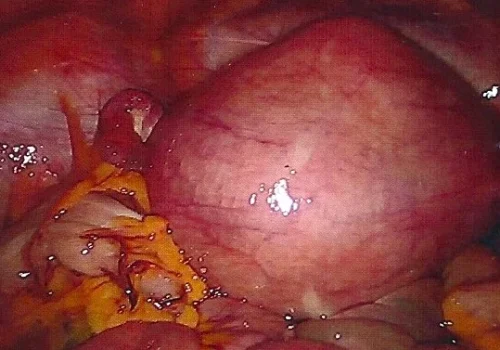 Large fibroid uterus